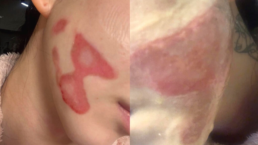 kwon-mina-shrink-burn-case-medical-procedure-safety (3)