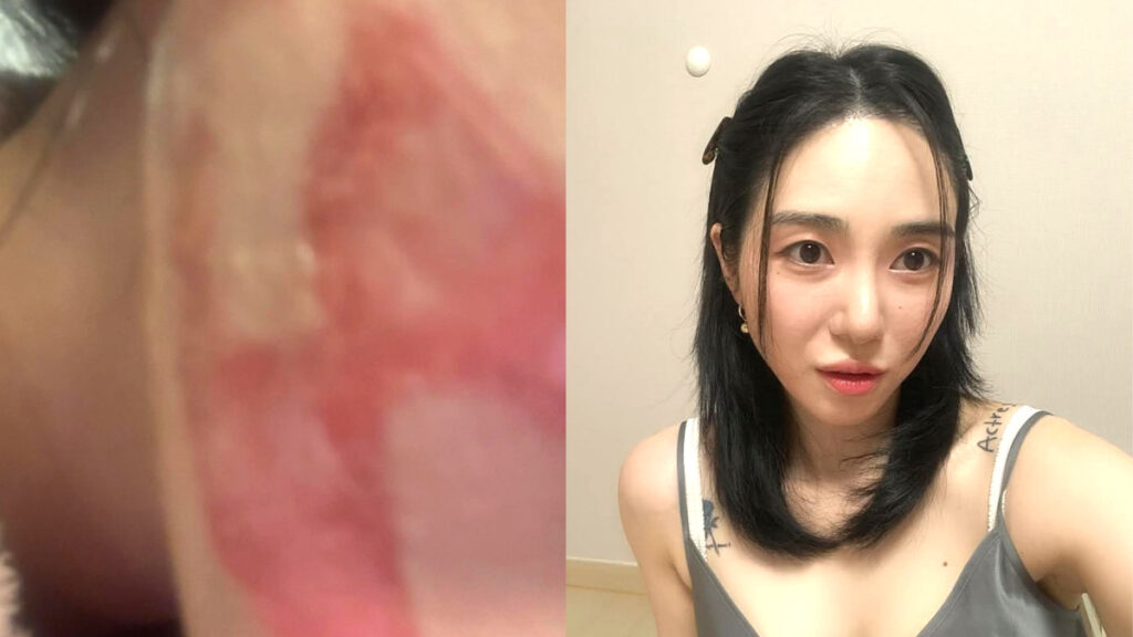 kwon-mina-shrink-burn-case-medical-procedure-safety (4)
